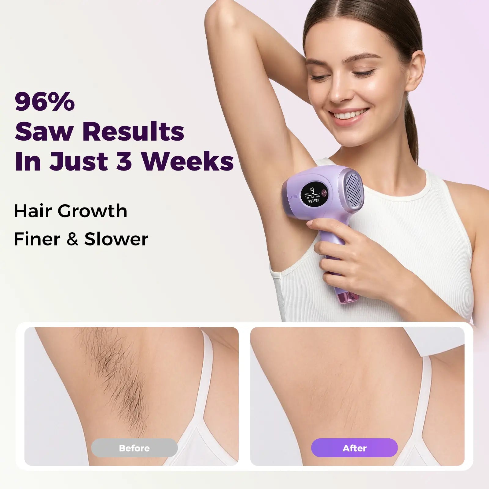 Ufree At-Home IPL Laser Hair Removal Device - Permanent Painless Hair Remover for Face, Bikini Line, Legs, Underarms - 990,000 Flashes